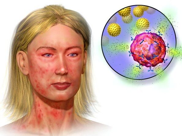 echinococi și simptome ale prezenței lor în organism