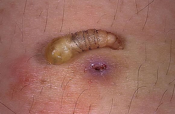 parazit larva subcutanată a omului